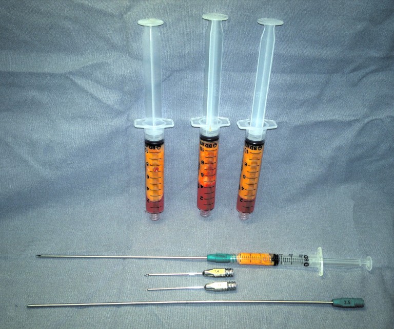 Lipofilling A Lipoenxertia Nas Mamas Cirurgia Pl Stica Dr